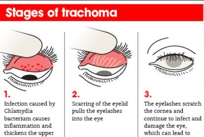 Egypt Becomes Seventh Country In WHO Eastern Mediterranean Region To Eliminate Trachoma After 3,000 Year Burden